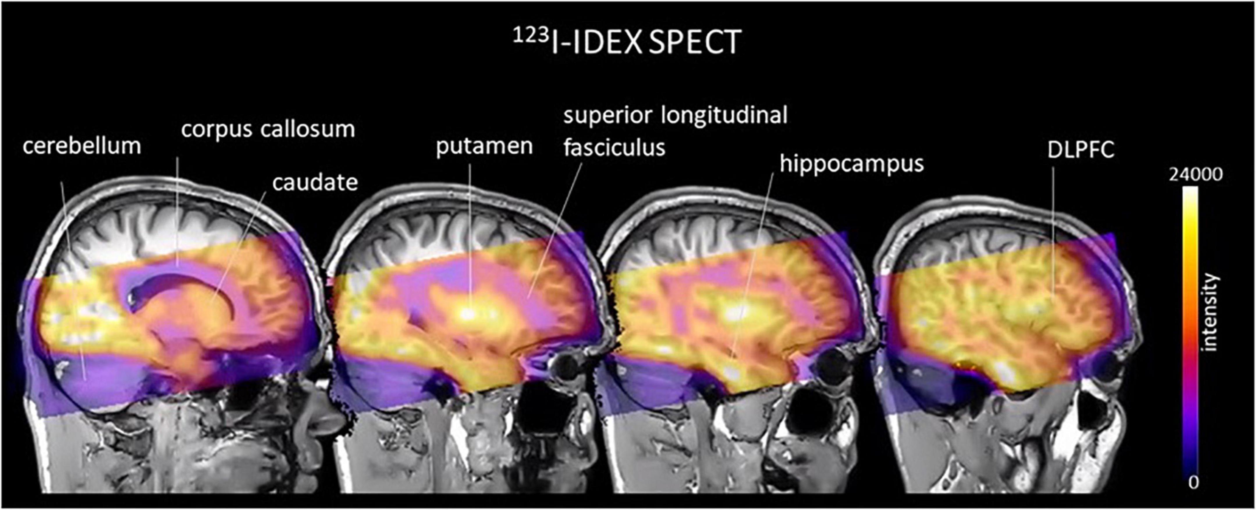 A growing understanding of the role of muscarinic receptors in the molecular pathology and treatment of schizophrenia